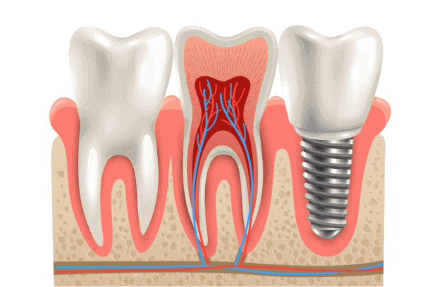 Single Tooth Implant Cost without Insurance