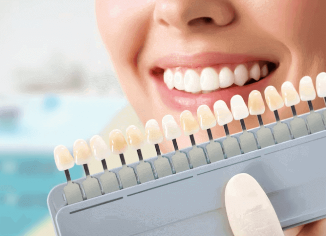 Does Insurance Cover Veneers